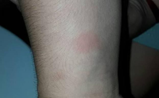 Picaduras de pulgas sufridas por un alumno esta semana. /Sur