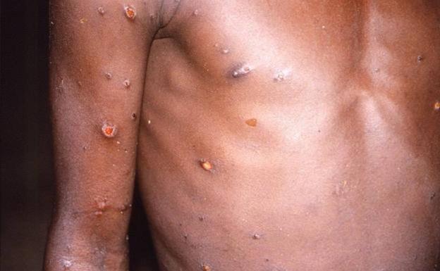 File image of a patient with monkeypox.