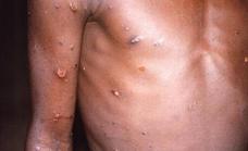 Suspected case of monkeypox virus investigated on the Costa del Sol