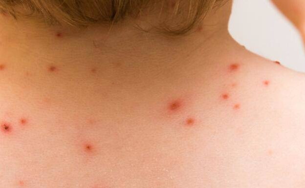 Monkeypox resembles smallpox in some ways, but is milder. 