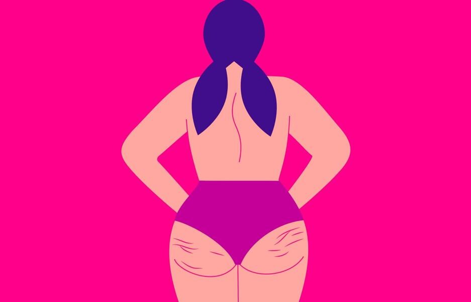 The 'lost' battle against cellulite
