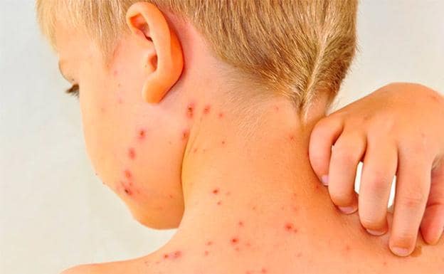 ¿Qué hacer cuando tu hijo tiene varicela?
