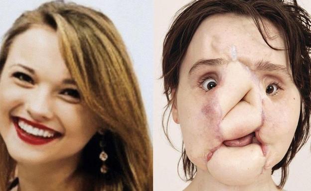 Katie Stubblefield, la mujer más joven del mundo en recibir un trasplante de cara completo