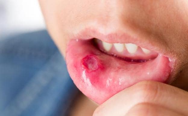 Temporada del boca-mano-pie: síntomas y tratamiento de un virus que se propaga entre bebés y niños