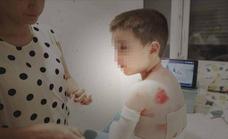 Piel de Mariposa: la investigación sugiere un futuro esperanzador para las familias