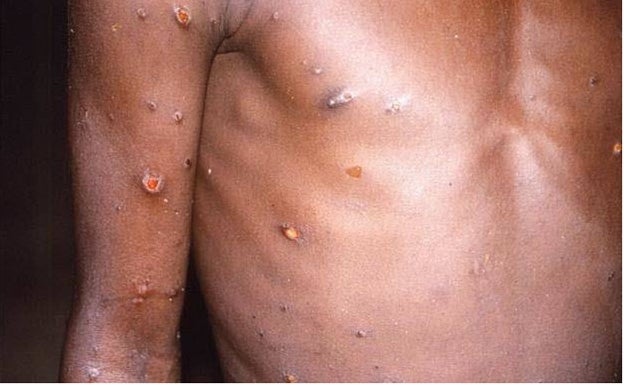 Sanidad eleva a tres los casos confirmados de viruela del simio en Málaga y siete en Andalucía