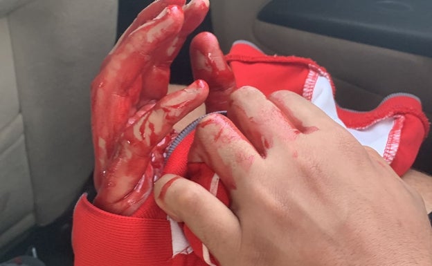 Herido grave un menor al cortarse con un contenedor en mal estado cuando tiraba la basura en Vélez-Málaga