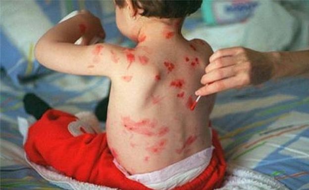 Organizaciones de Mayores recuerdan que Andalucía está «a la cola» en la implantación de la vacuna del herpes zóster