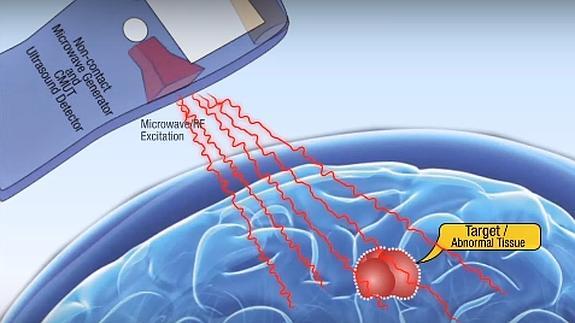 Tecnología por ultrasonido para detectar de forma remota un cáncer